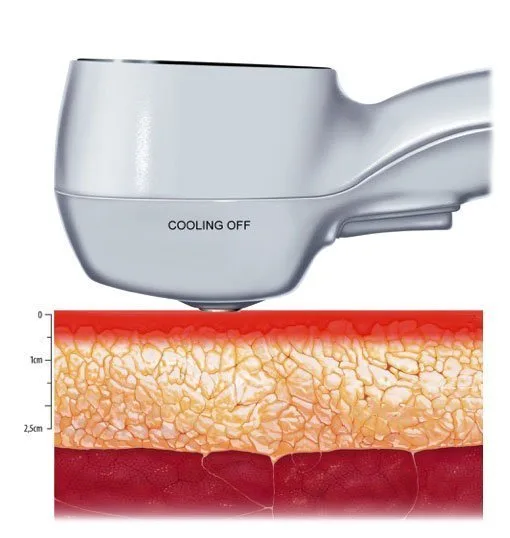 carmen sarmiento exilis elite 0 off