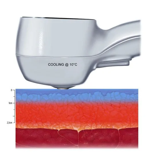 carmen sarmiento exilis elite 1 10