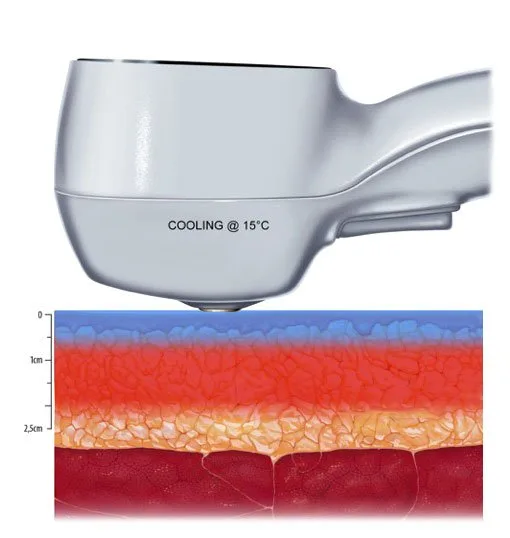 carmen sarmiento exilis elite 2 15