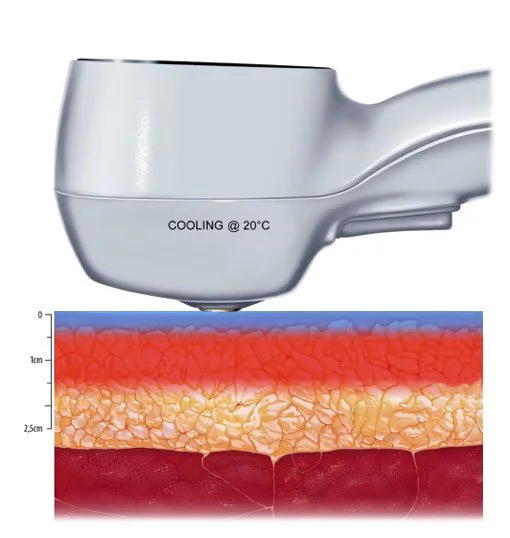 carmen sarmiento exilis elite 3 20