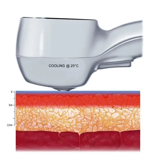 carmen sarmiento exilis elite 4 25