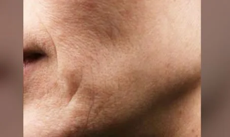 Nature Antiage III solo en Carmen Sarmiento. Combina tres tecnologías vanguardistas muy desarrolladas, que actúan a tres niveles: Epidermis, Dermis, SMAS.