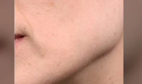 Nature Antiage III solo en Carmen Sarmiento. Combina tres tecnologías vanguardistas muy desarrolladas, que actúan a tres niveles: Epidermis, Dermis, SMAS.