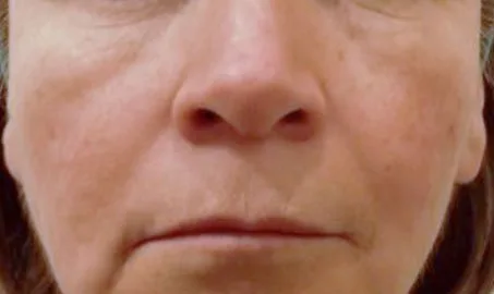 Nature Antiage III solo en Carmen Sarmiento. Combina tres tecnologías vanguardistas muy desarrolladas, que actúan a tres niveles: Epidermis, Dermis, SMAS.