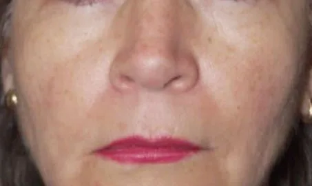 Nature Antiage III solo en Carmen Sarmiento. Combina tres tecnologías vanguardistas muy desarrolladas, que actúan a tres niveles: Epidermis, Dermis, SMAS.