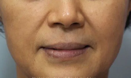 Nature Antiage III solo en Carmen Sarmiento. Combina tres tecnologías vanguardistas muy desarrolladas, que actúan a tres niveles: Epidermis, Dermis, SMAS.