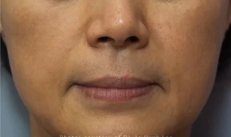 Nature Antiage III solo en Carmen Sarmiento. Combina tres tecnologías vanguardistas muy desarrolladas, que actúan a tres niveles: Epidermis, Dermis, SMAS.