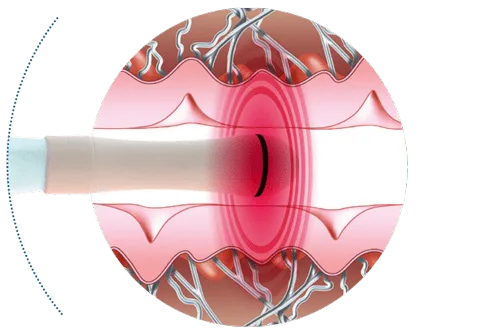 Exilis Elite Ultra Femme 360º 4 carmen sarmiento nature antiage exilis elite ultra femme 360 2