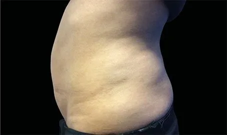 EMSCULPT NEO 4 Muestra de antes y después.