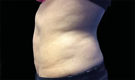 EMSCULPT NEO 5 Muestra de antes y después.