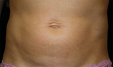 EMSCULPT NEO 7 Muestra de antes y después.