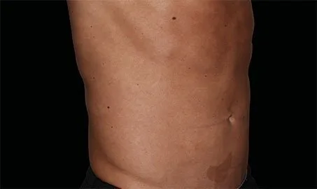 EMSCULPT NEO 8 Muestra de antes y después.