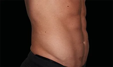 EMSCULPT NEO 9 Muestra de antes y después.