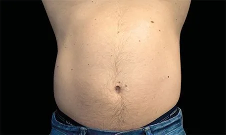 EMSCULPT NEO 10 Muestra de antes y después.