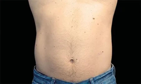 EMSCULPT NEO 11 Muestra de antes y después.