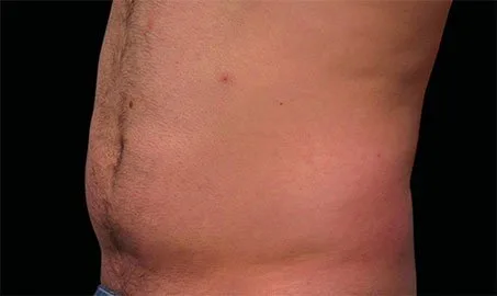 EMSCULPT NEO 12 Muestra de antes y después.