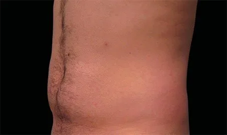 EMSCULPT NEO 13 Muestra de antes y después.