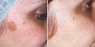 carmen-sarmiento-skin-lifting-laser-4d-antes-y-despues-2 carmen sarmiento skin lifting laser 4d antes y despues 2