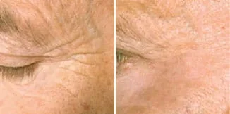carmen-sarmiento-skin-lifting-laser-4d-antes-y-despues-3 carmen sarmiento skin lifting laser 4d antes y despues 3