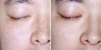 carmen-sarmiento-skin-lifting-laser-4d-antes-y-despues-4 carmen sarmiento skin lifting laser 4d antes y despues 4