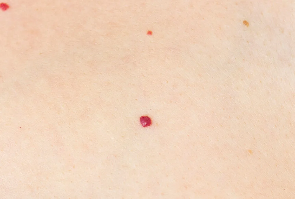 Qué son y como eliminar los puntos de rubí en 2022. Los puntos rubí son pequeños bultos de color rojo brillante en al piel.