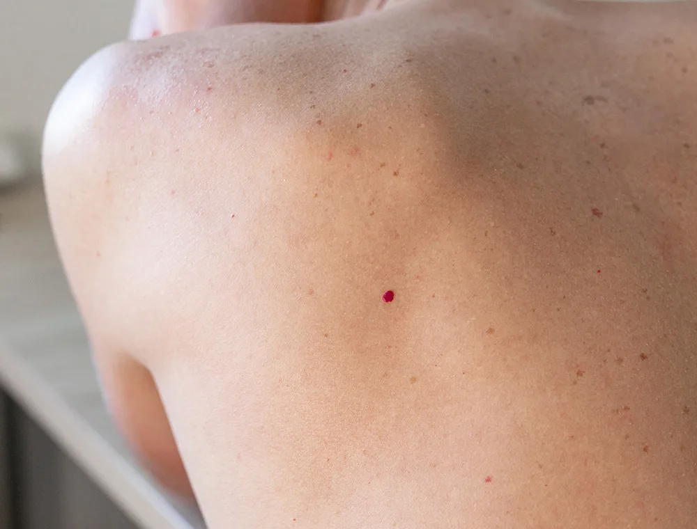 Eliminar los puntos de rubi Eliminar los puntos de rubi