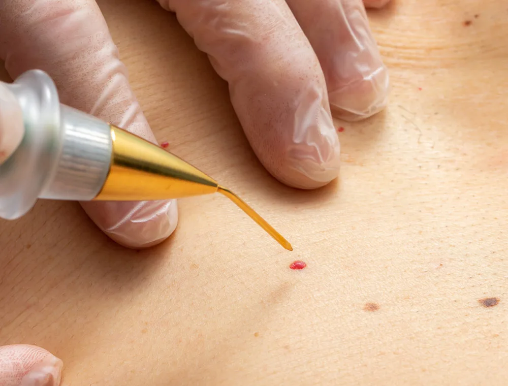 Eliminar los puntos de rubi Eliminar los puntos de rubi