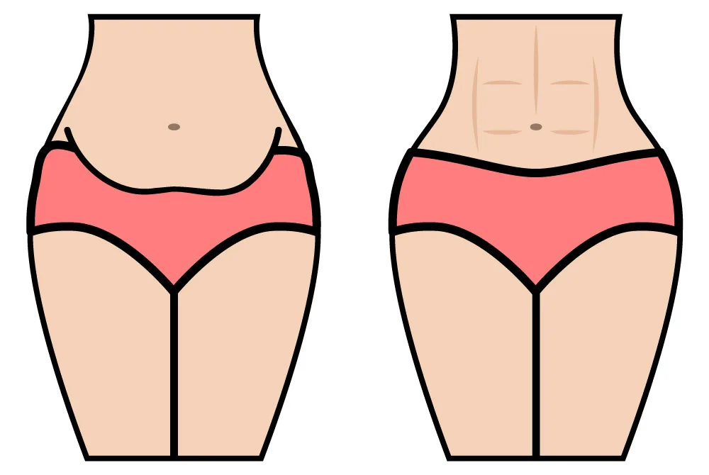 Elimina la Vientre flácido y laxitud abdominal en Carmen Sarmiento