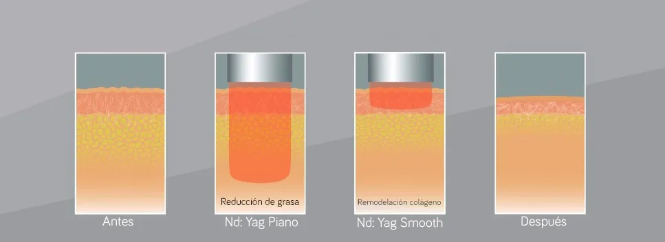 Elimina la Vientre flácido y laxitud abdominal en Carmen Sarmiento