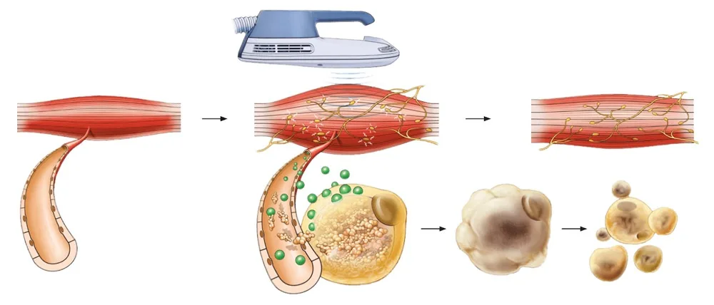 Elimina la Vientre flácido y laxitud abdominal en Carmen Sarmiento