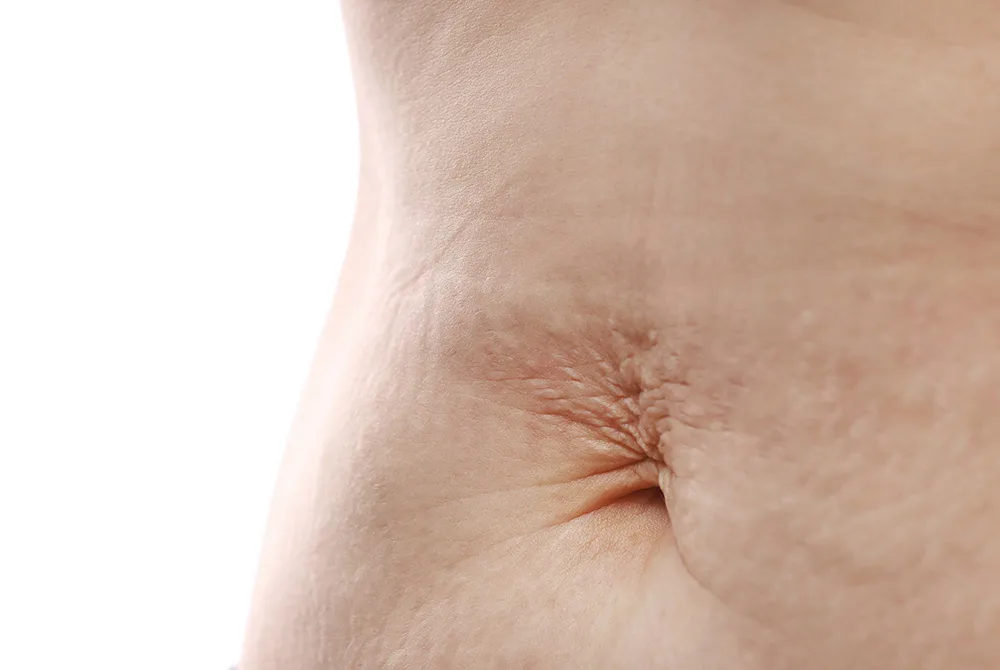 Elimina la Vientre flácido y laxitud abdominal en Carmen Sarmiento