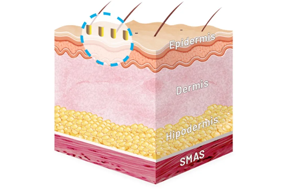 Elimina las manchas del escote tras el verano en Carmen Sarmiento