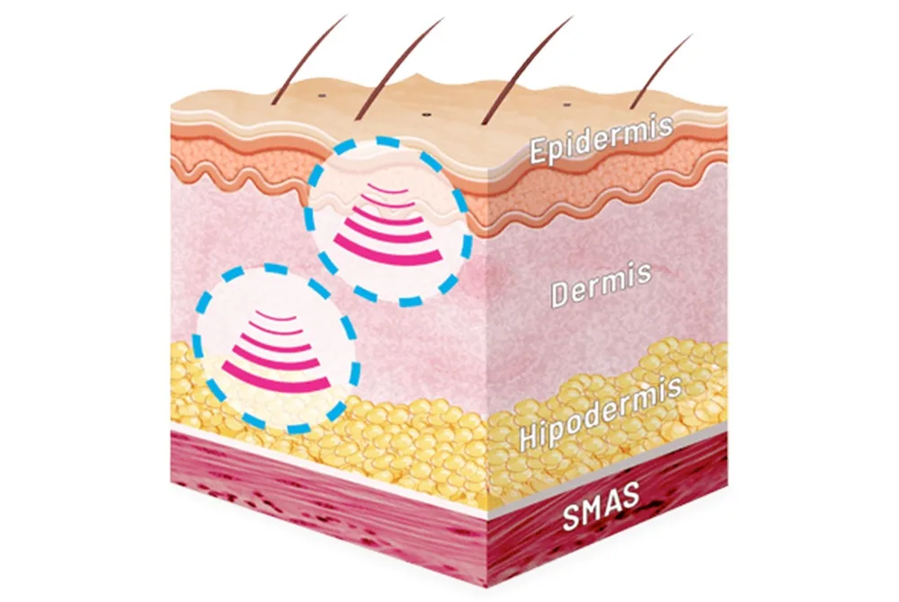 Elimina las manchas del escote tras el verano en Carmen Sarmiento