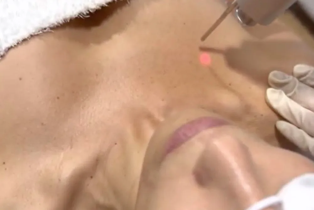 Elimina las manchas del escote tras el verano en Carmen Sarmiento