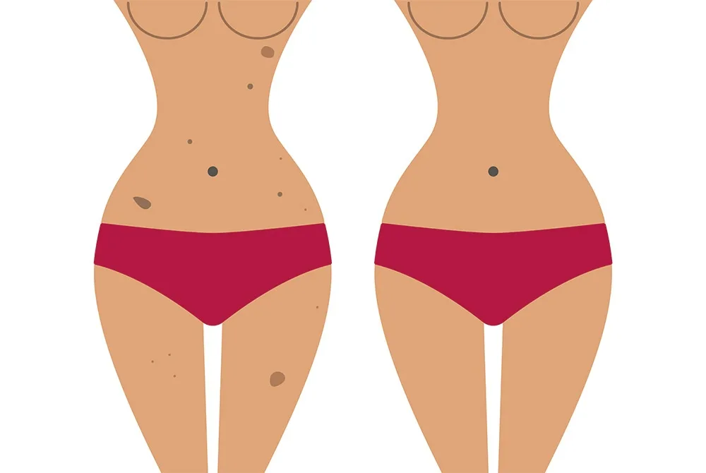 Tratamiento del Melasma: qué es, causas y tratamiento Tratamiento del Melasma: qué es, causas y tratamiento