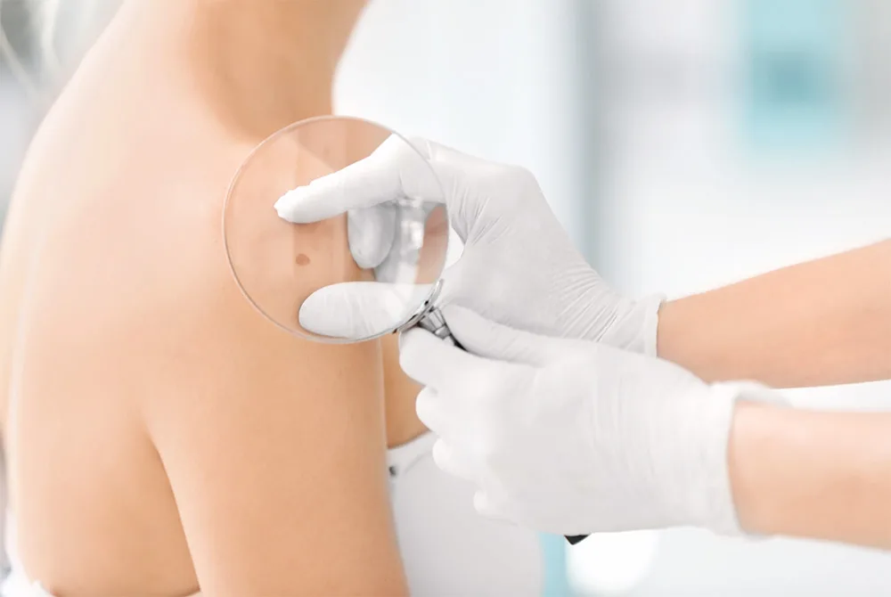 Tratamiento del Melasma: qué es, causas y tratamiento Tratamiento del Melasma: qué es, causas y tratamiento