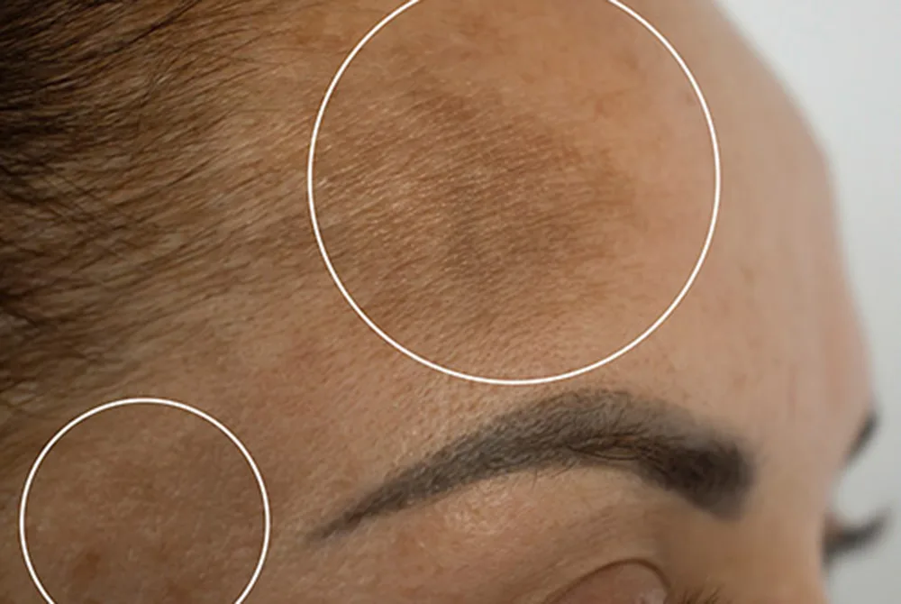 Tratamiento del Melasma: qué es, causas y tratamiento Tratamiento del Melasma: qué es, causas y tratamiento