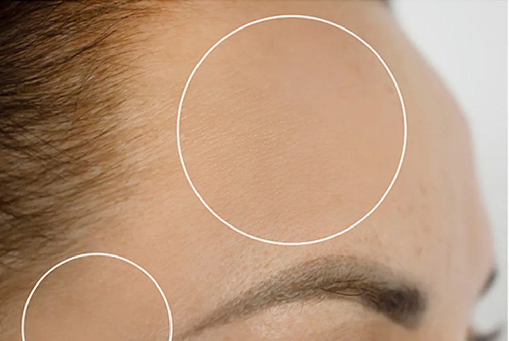 Tratamiento del Melasma: qué es, causas y tratamiento Tratamiento del Melasma: qué es, causas y tratamiento