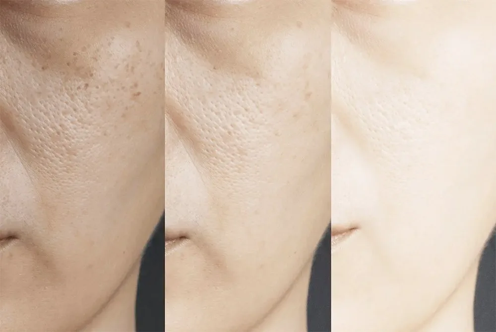 Tratamiento del Melasma: qué es, causas y tratamiento Elimina las manchas del escote tras el verano en Carmen Sarmiento