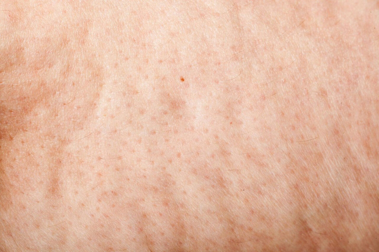 Celulitis edematosa, qué es, síntomas, causas y tratamiento