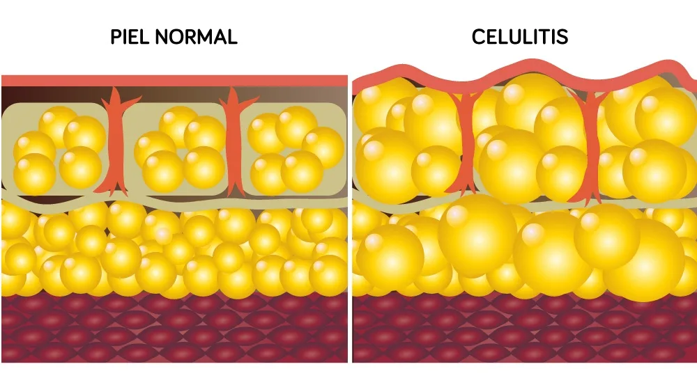 Celulitis edematosa, trátala con eficacia en Carmen Sarmiento