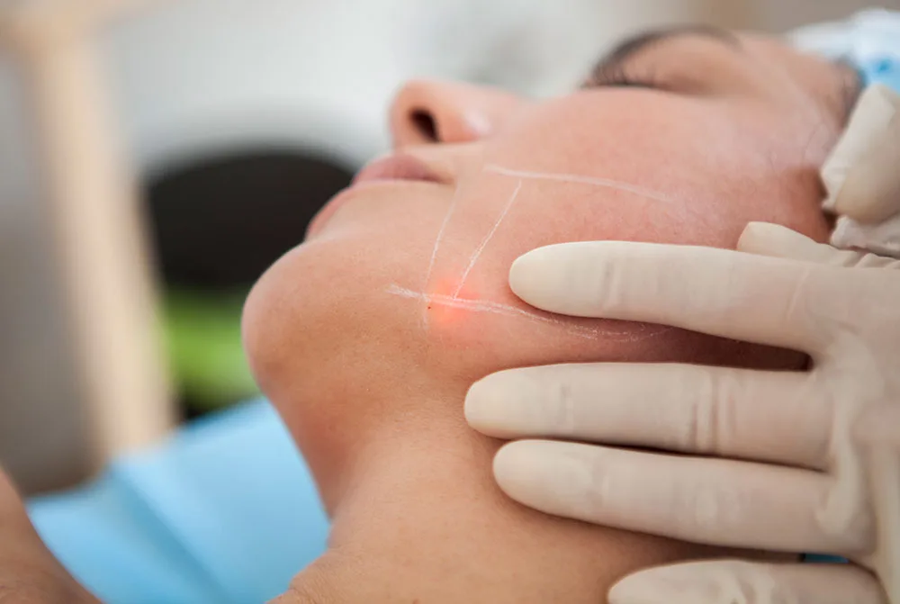 Cómo marcar la mandíbula, consíguelo en CS con Endolobal Skin Lifting