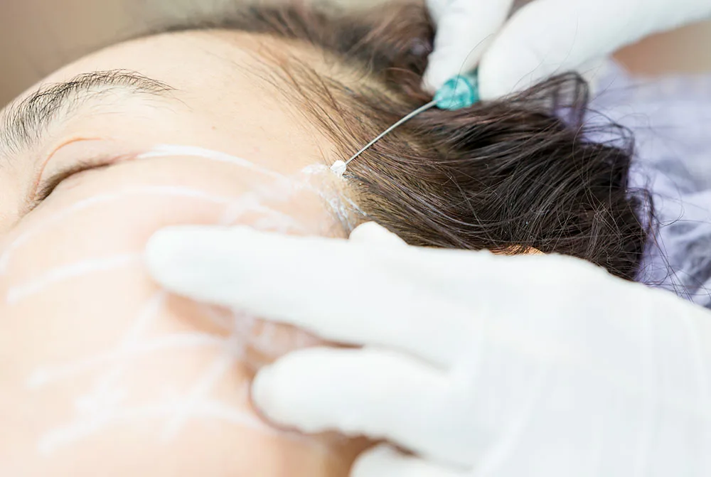 Cómo marcar la mandíbula, hilos aptos