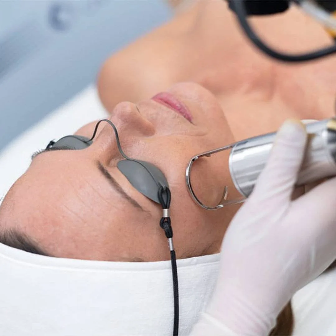 Láser CO2 fraccionado Centros Carmen Sarmiento