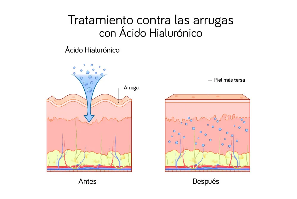 Arrugas labio superior, como prevenirlas y tratarlas