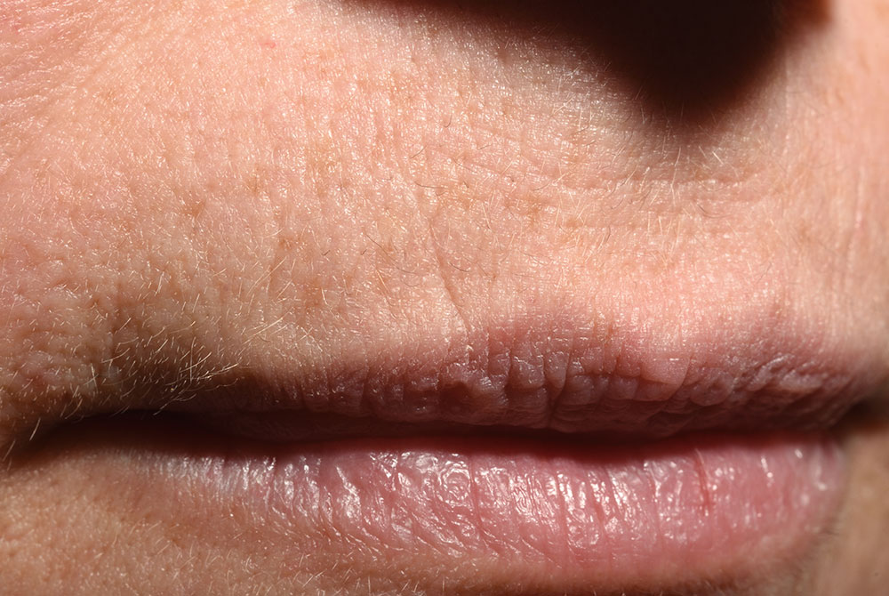 Arrugas del labio superior, como prevenirlas y tratarlas