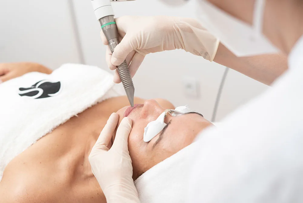 Arrugas del labio superior, como prevenirlas y tratarlas con Fotona en Carmen Sarmiento