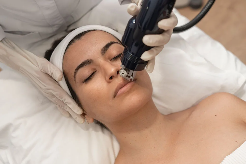 Arrugas del labio superior, como prevenirlas y tratarlas con Fractional Touch System en Carmen Sarmiento