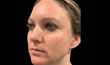 EMFACE Volumen facial sin relleno - Antes y después