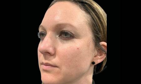 EMFACE Volumen facial sin relleno - Antes y después